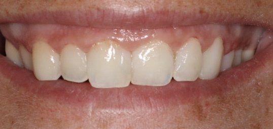 Custom teeth whitening in Osborne, KS for a brighter smile.