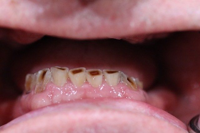 Dental veneers in Osborne, KS to repair and reshape teeth.