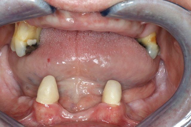 Durable dental implants in Osborne, KS for lasting results.