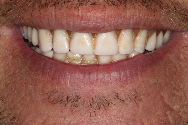 Dental veneers in Osborne, KS to repair and reshape teeth.