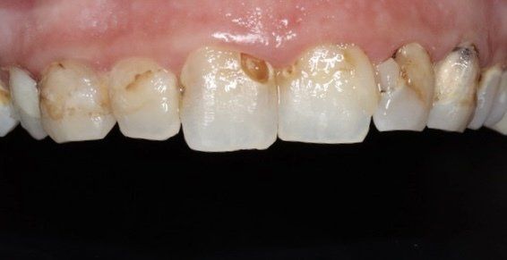 Custom teeth whitening in Osborne, KS for a brighter smile.