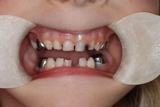 Root canal treatment in Osborne, KS to save infected teeth.