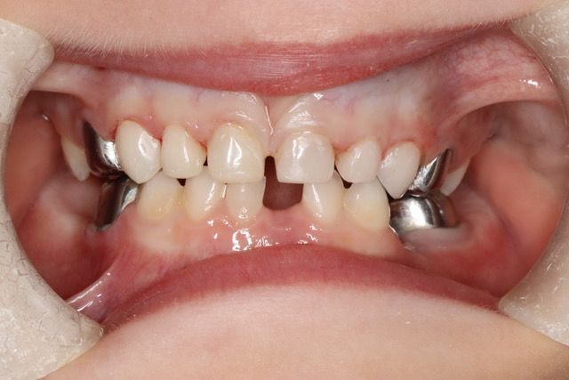 Root canal treatment in Osborne, KS to save infected teeth.