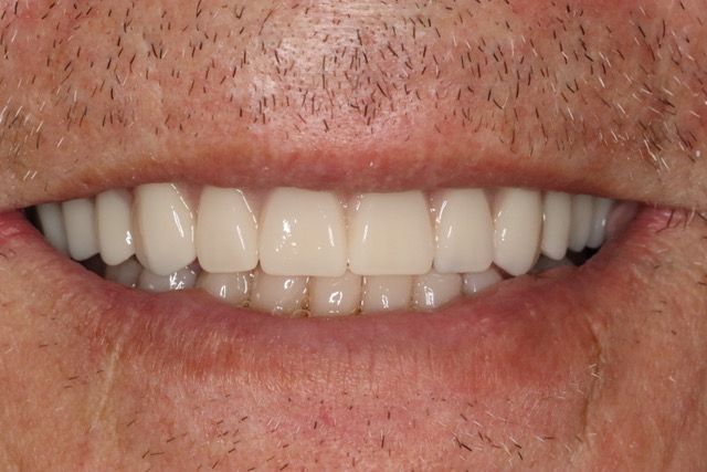 Affordable dentures in Osborne, KS to replace missing teeth.