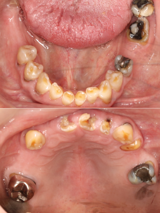 Root canal treatment in Osborne, KS to save infected teeth.
