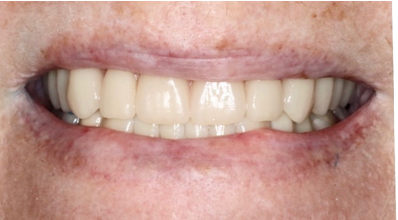 Affordable dentures in Osborne, KS to replace missing teeth.