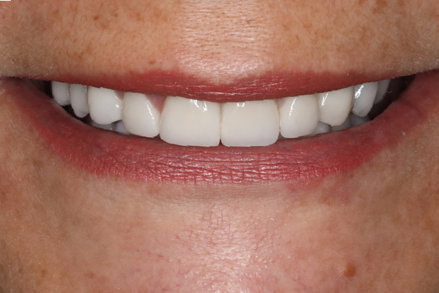 Custom teeth whitening in Osborne, KS for a brighter smile.