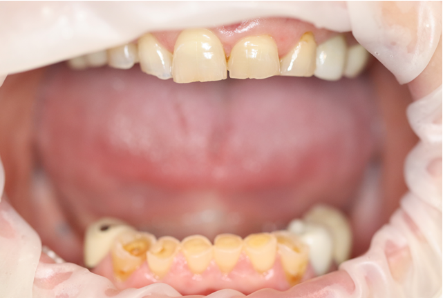 Durable dental implants in Osborne, KS for lasting results.