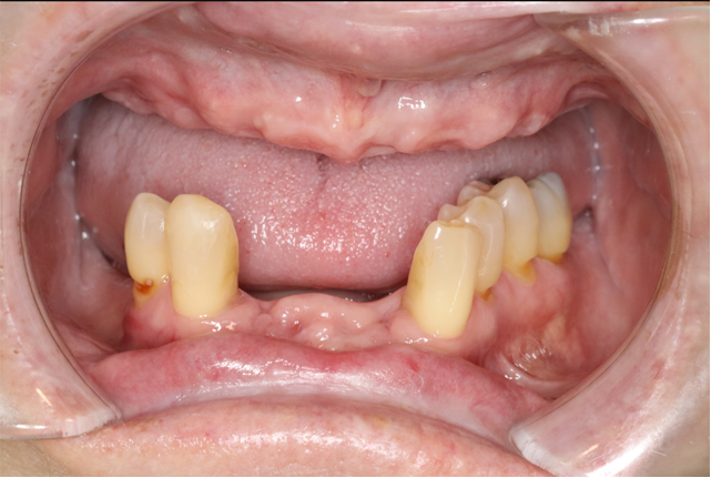Affordable dentures in Osborne, KS to replace missing teeth.