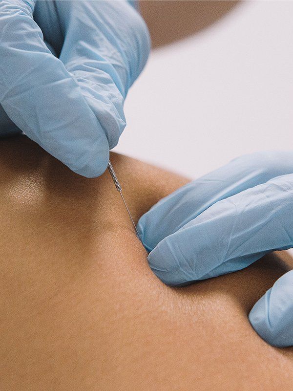 Dry Needling Therapy provided at Southwind Physical Therapy in Salina KS