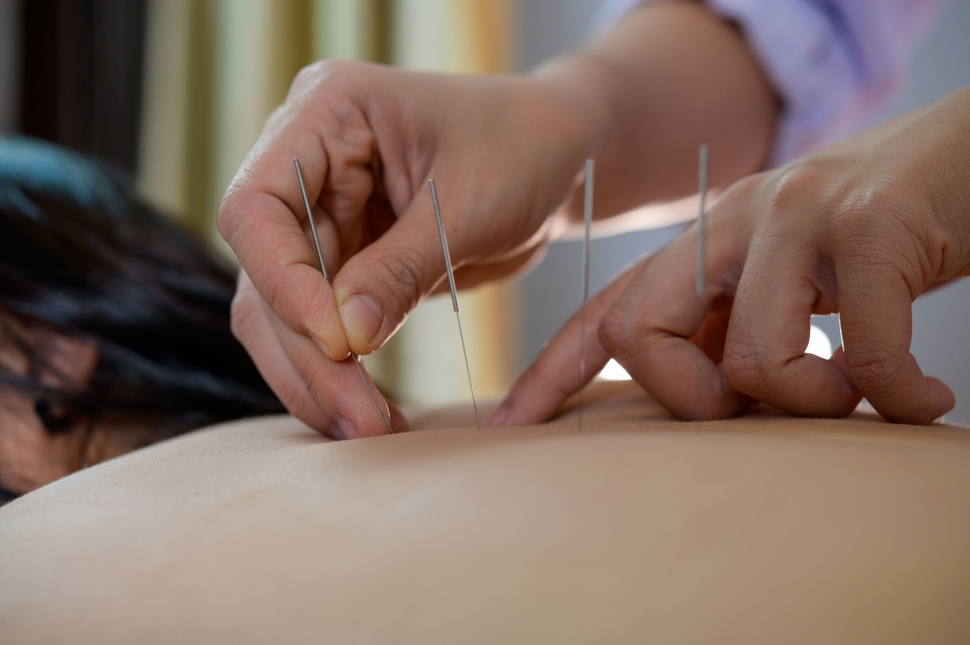 acupuncture treatment