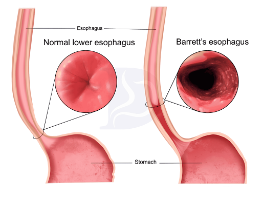 Barrett's Esophagus