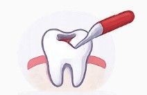 Tooth being filled with a dental drill, showing a cavity repair procedure