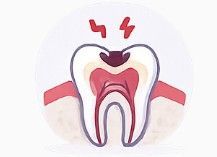 Illustration of a tooth with red pain marks and exposed inner root, indicating toothache or decay