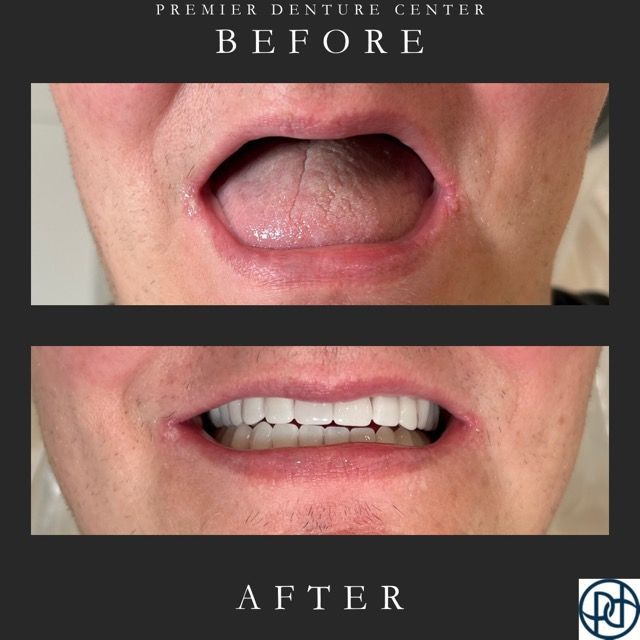 Before and after photos showing a mouth without and with a full set of dentures.