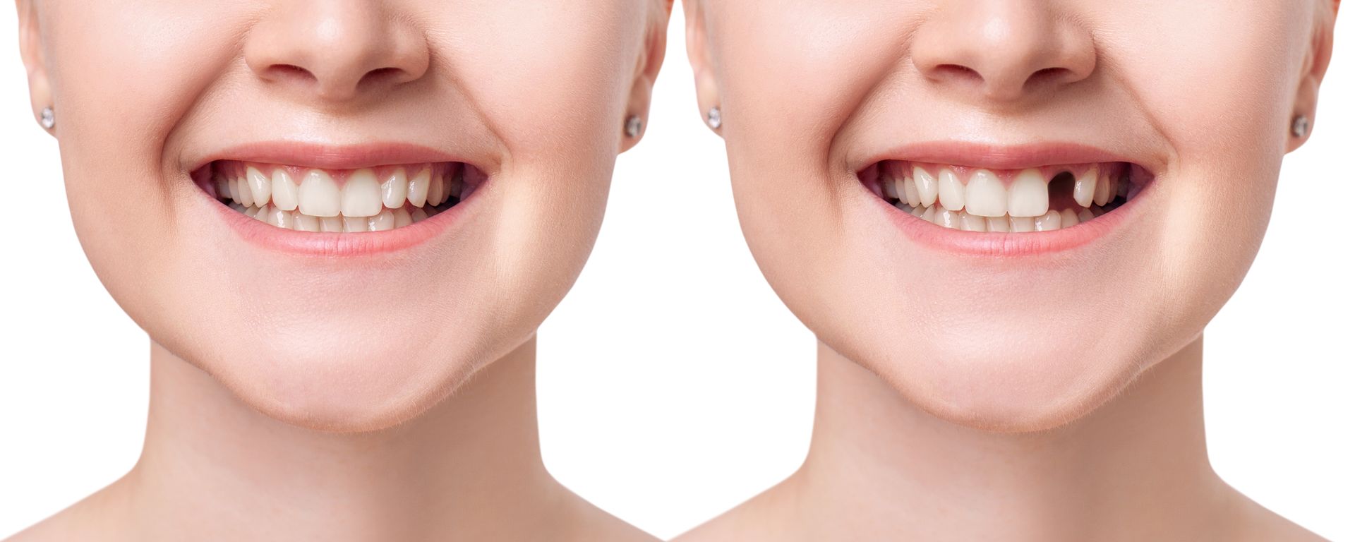 Close-up of a person's smiling mouth showing straight, white teeth. The lips are lightly parted.