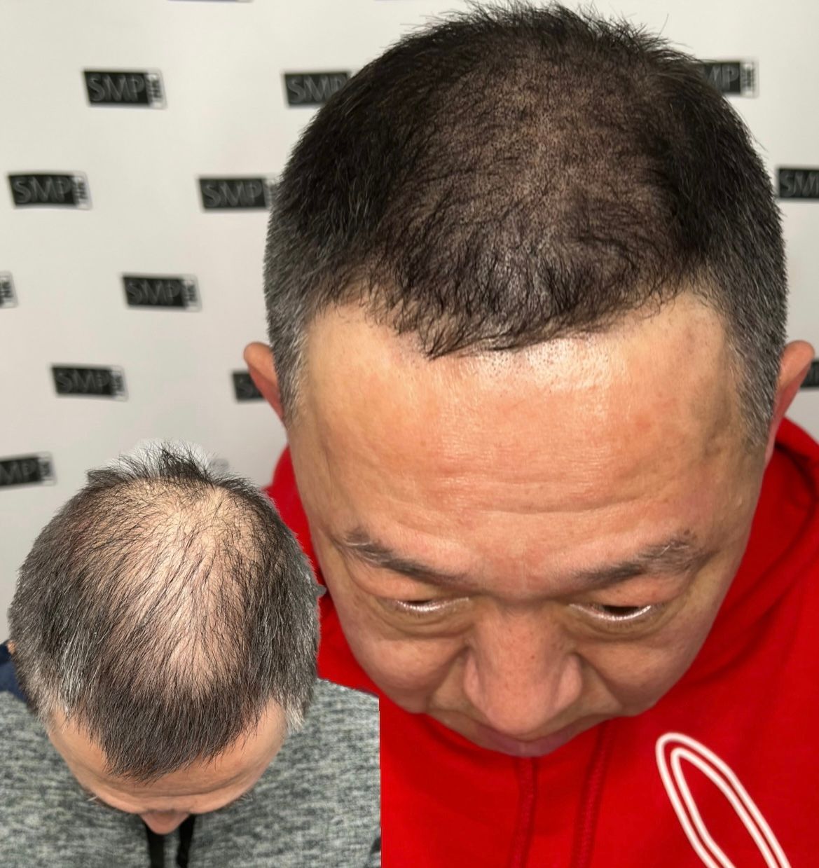 Man with hair regrowth before and after treatment; in red sweater, overhead view.