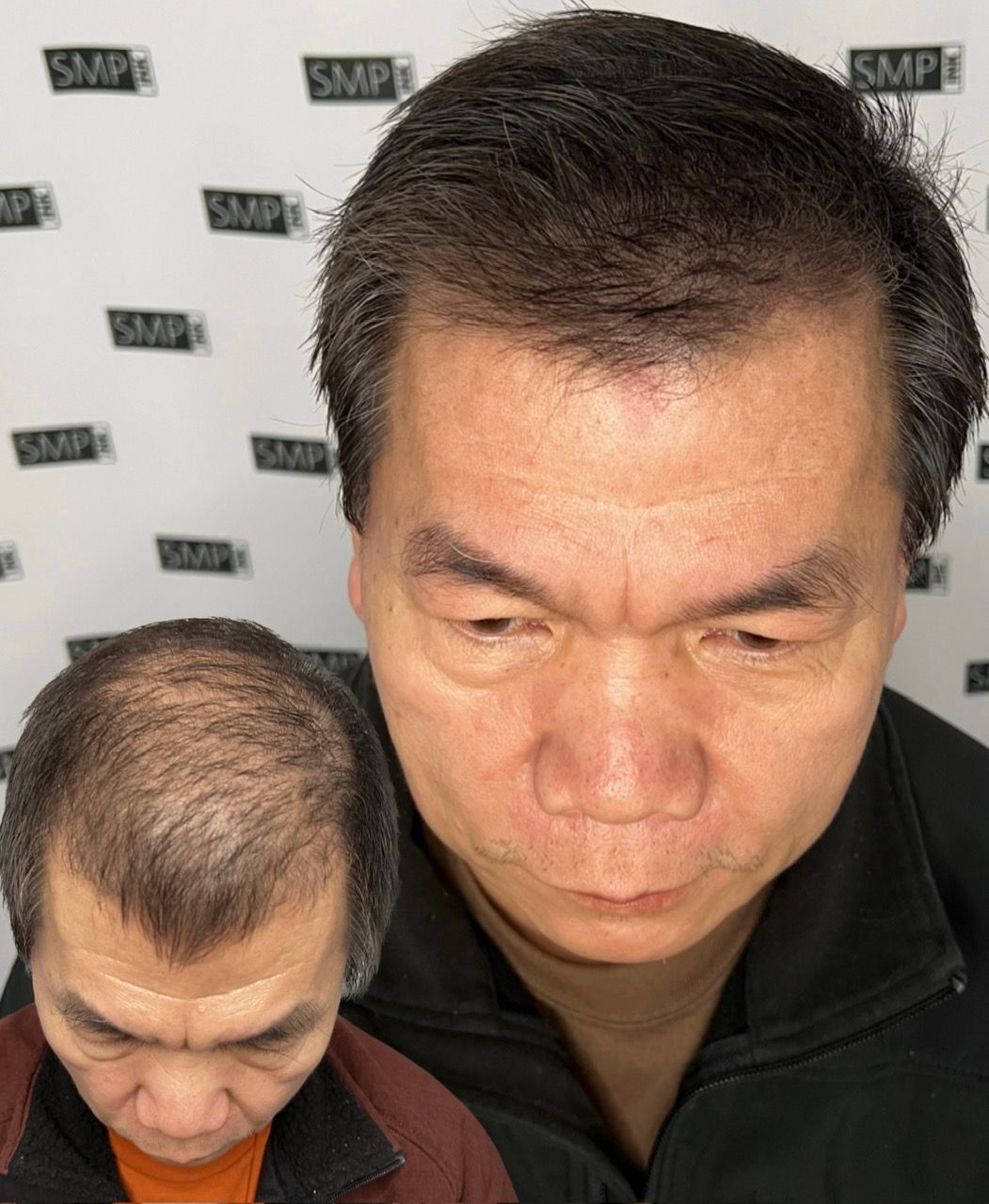 Man's scalp before and after hair restoration. He looks down; the background is branded 