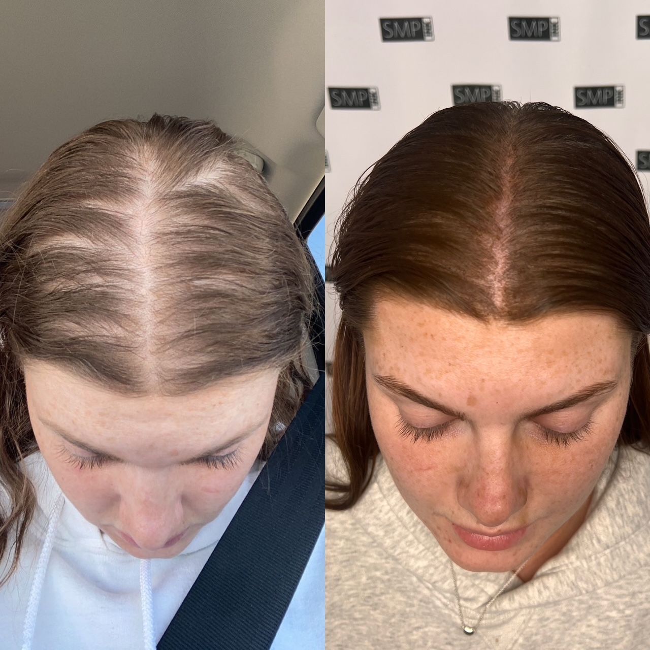 Before and after scalp micropigmentation of a woman with thinning hair, showing fuller appearance.