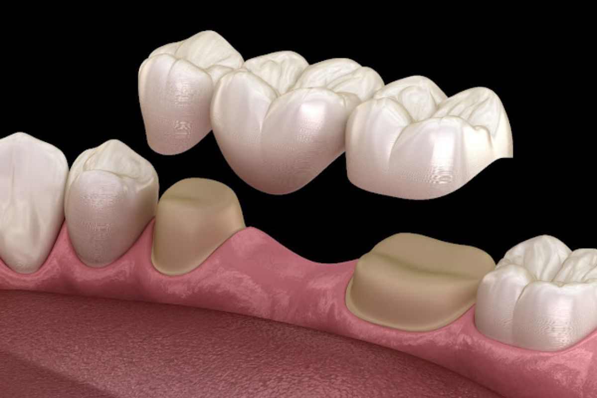 Dental bridge replacing missing teeth; brown supporting crowns on adjacent teeth, white replacement teeth.