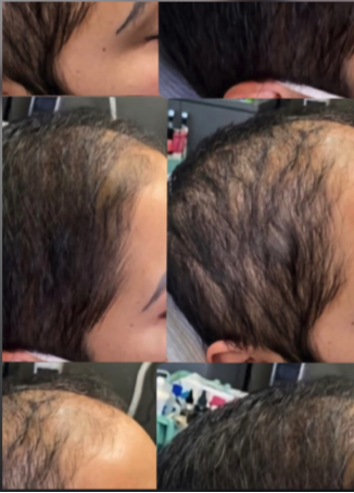 A before-and-after comparison showing hair density improvement on the side of a scalp.