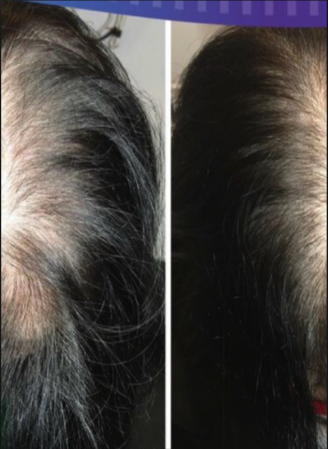 Side-by-side comparison of a scalp showing hair density improvement, with the right side appearing fuller than the left.