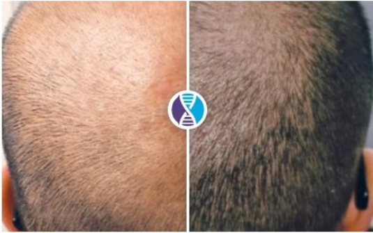 Before-and-after comparison showing hair regrowth on the scalp with a logo in the center.