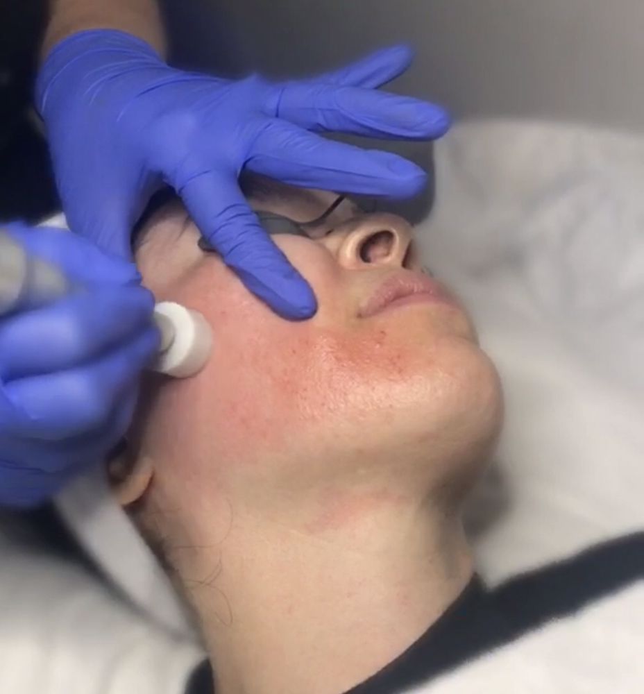 A woman is getting a hydrafacial treatment on her face.