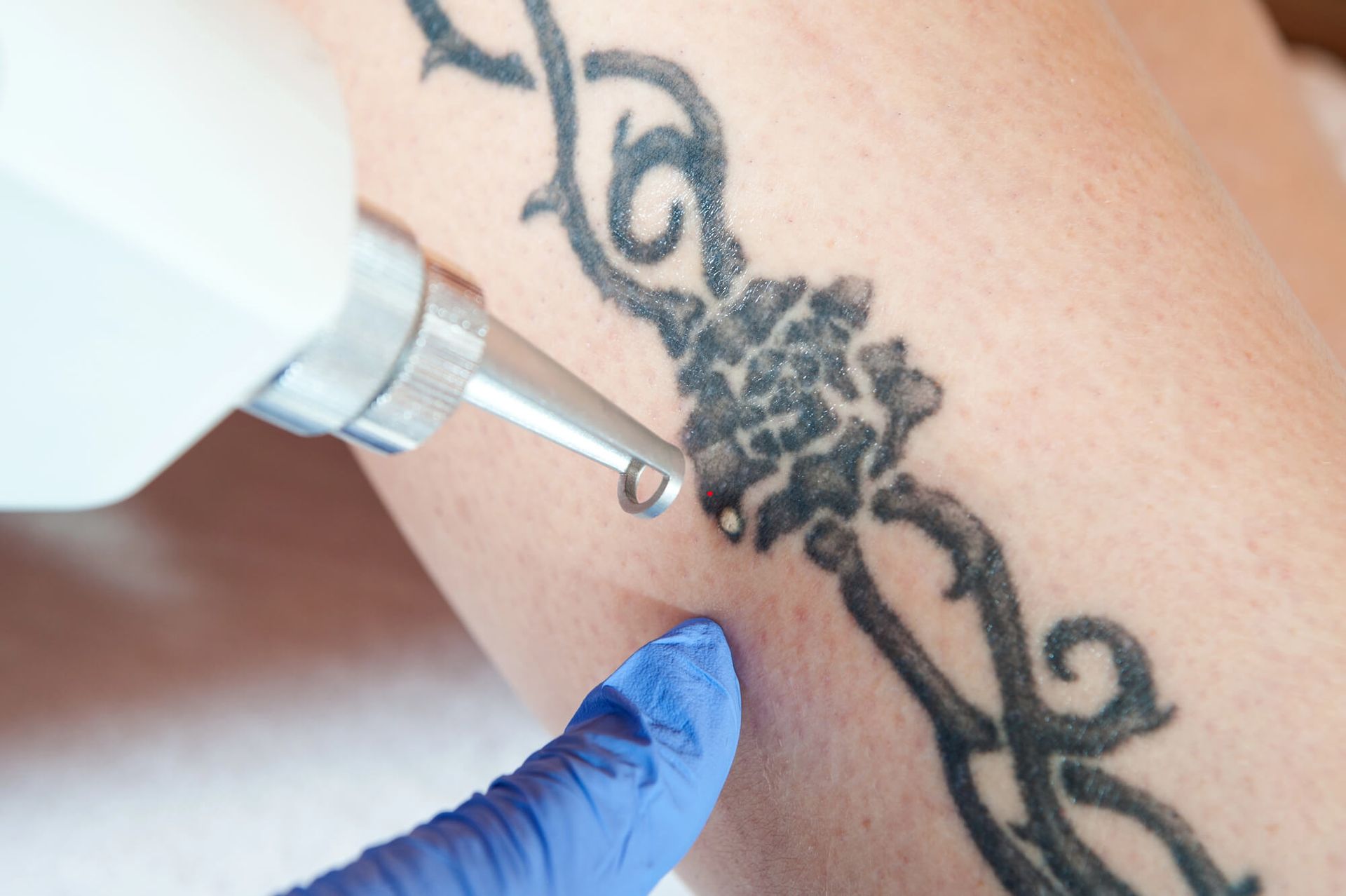 A person’s shoulder showing a tattoo fading in four stages labeled 1x through 4x, demonstrating the tattoo removal process.