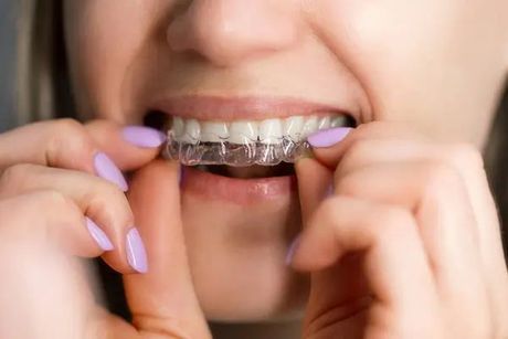 Mani che posizionano un allineatore trasparente sui denti, primo piano di una bocca sorridente.