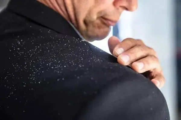 Does dandruff cause hair loss?