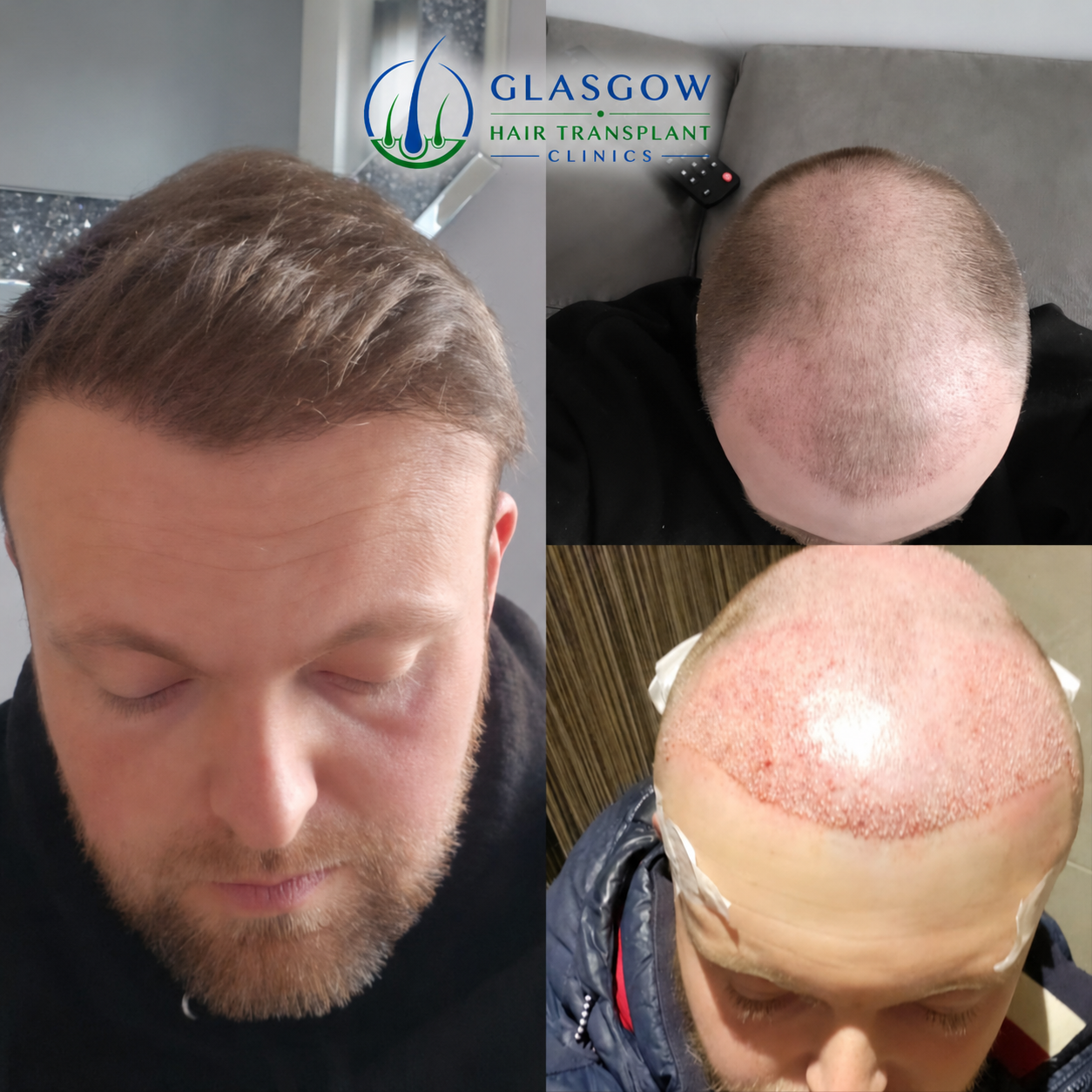 Hair restoration result
