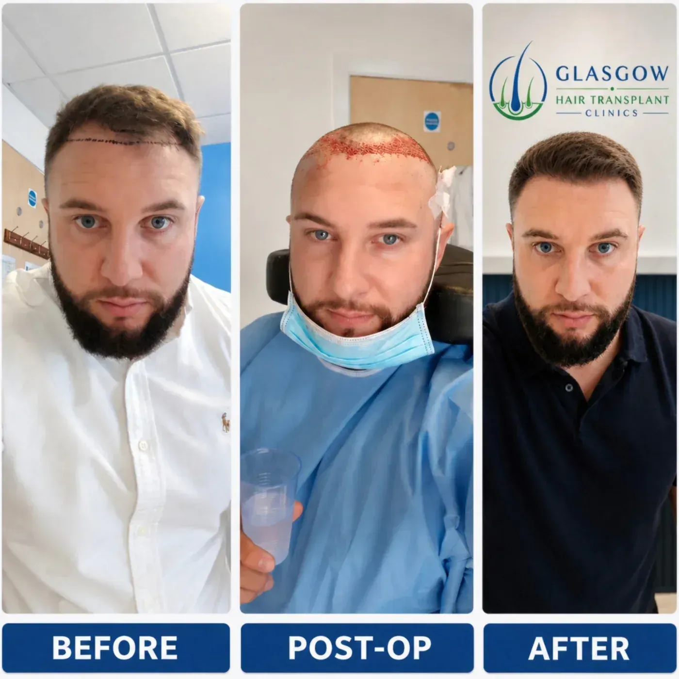 Temple and hairline transplant before and after 2,300 grafts