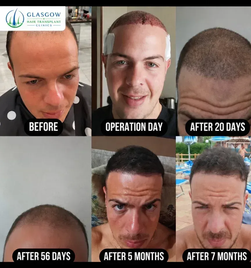 Before and approximately 12-month result after a 3,500 graft widow's peak hair transplant