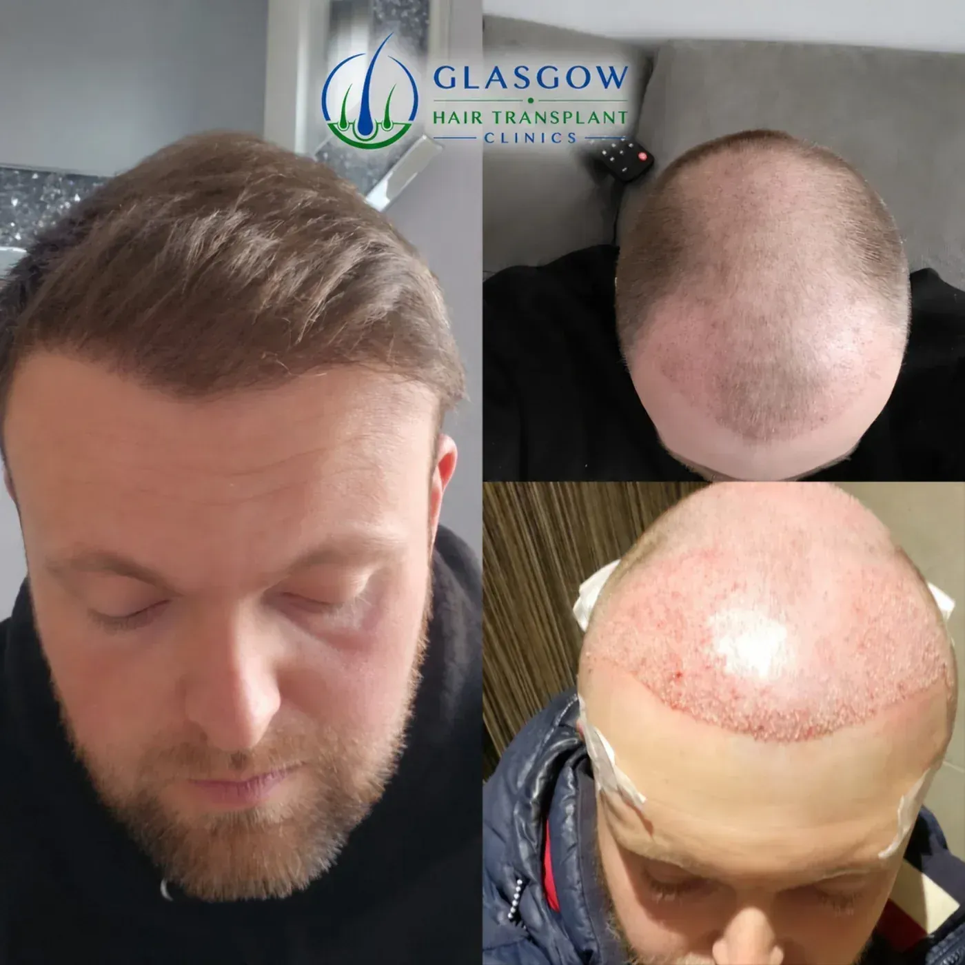 Hair transplant treatment result