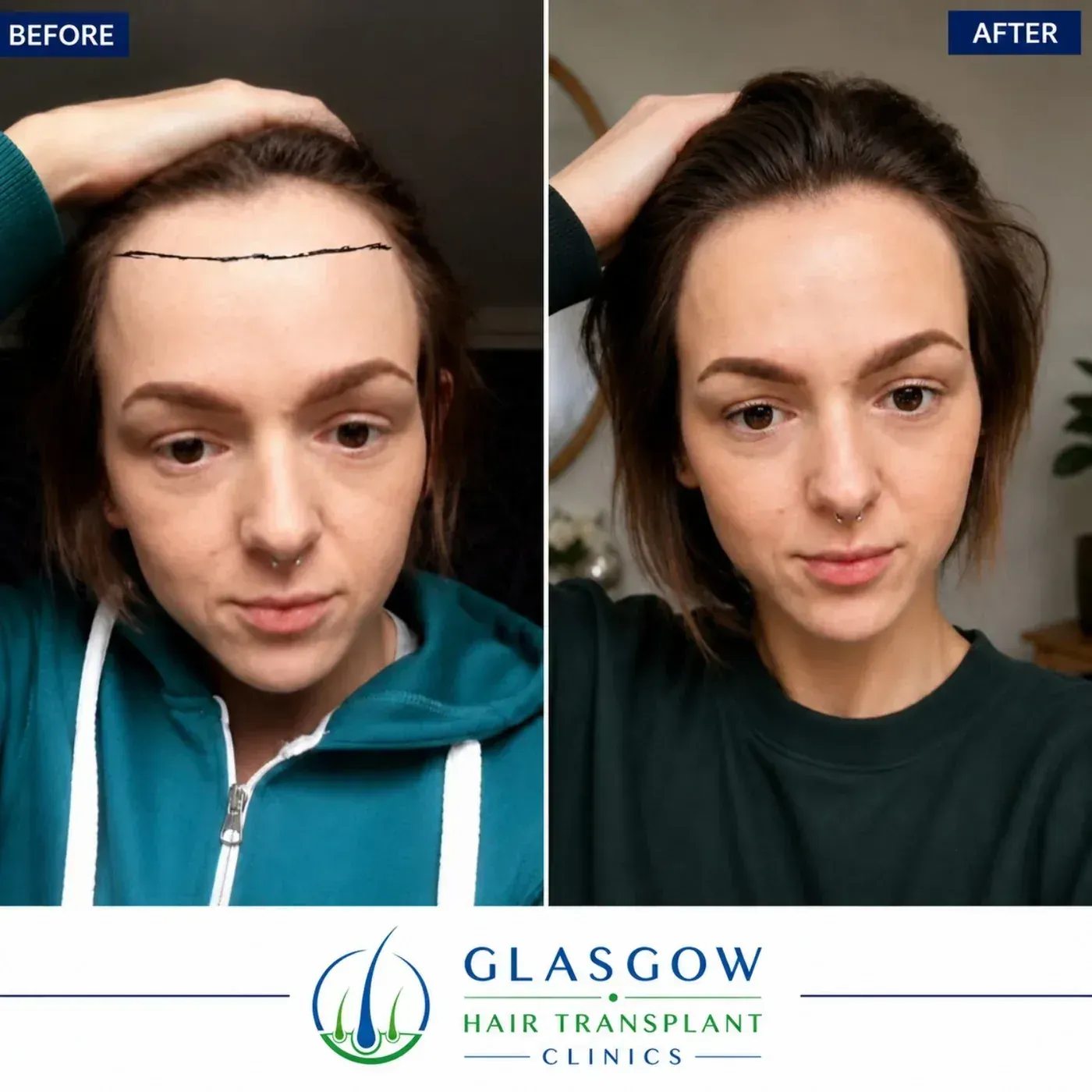 Rebecca's hairline transplant result