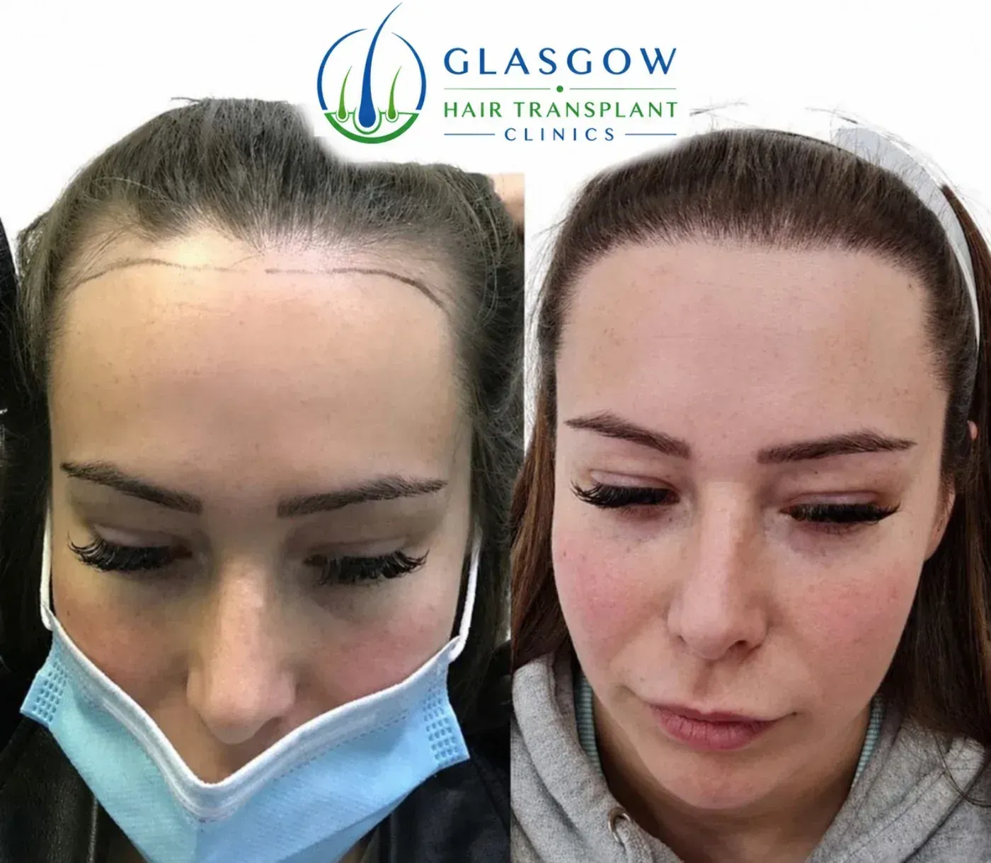 Hair restoration before and after