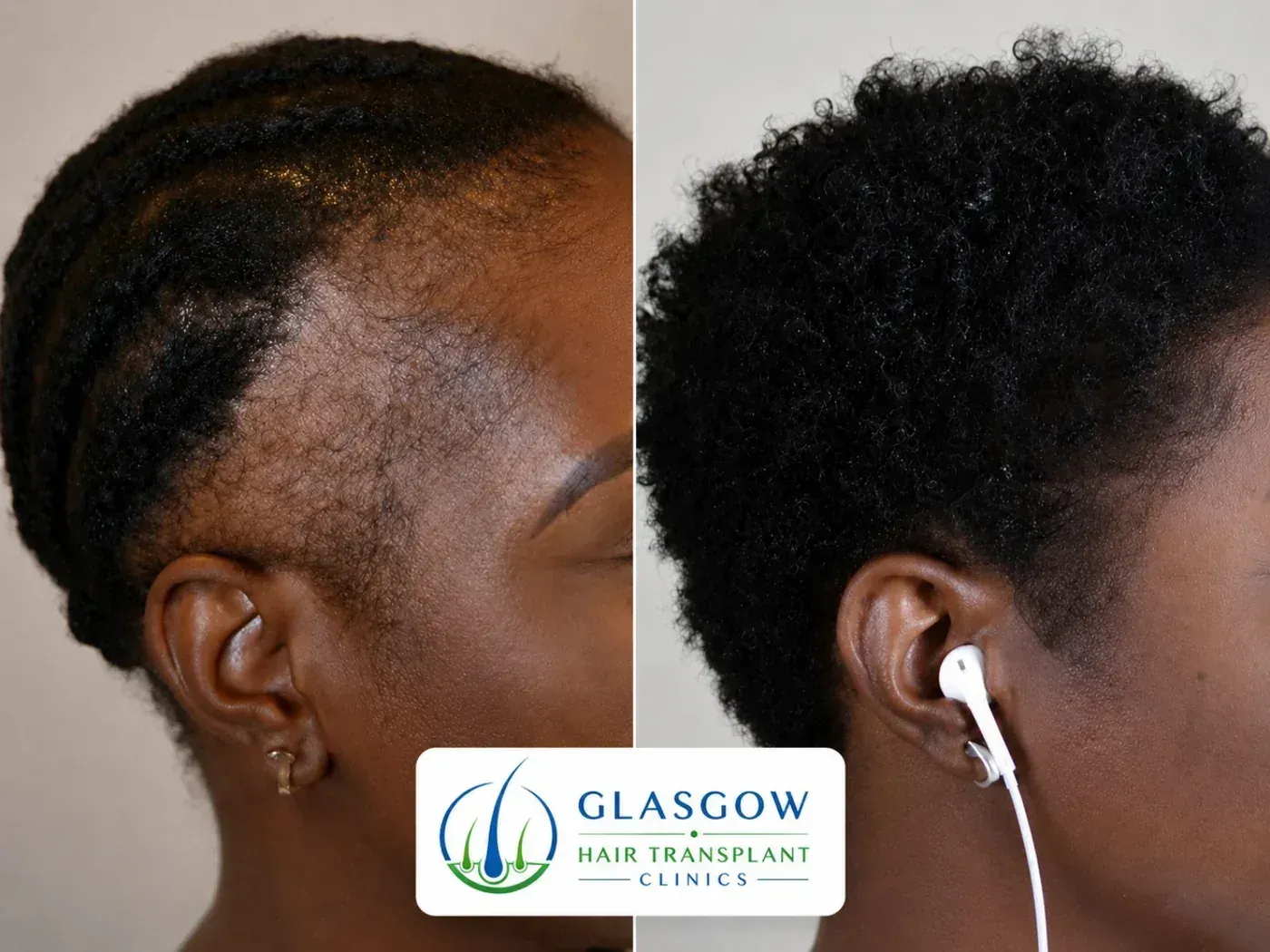 Afro textured hair transplant patient result