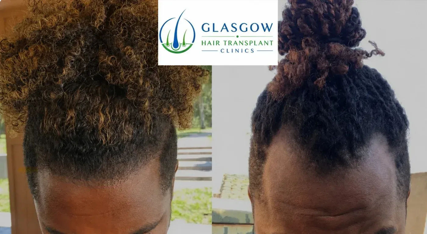 Afro hair restoration patient result