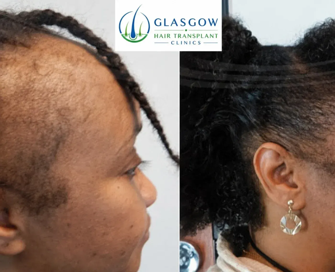 Curly hair transplant before and after result