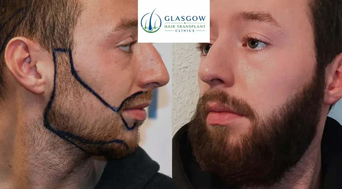 Beard transplant before and after result