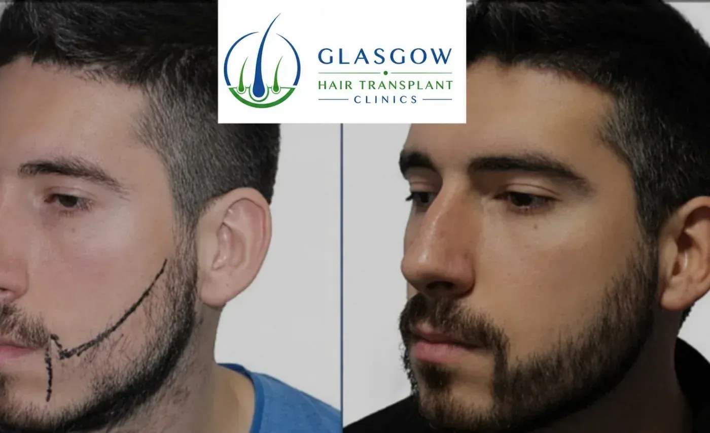 Beard transplant patient result