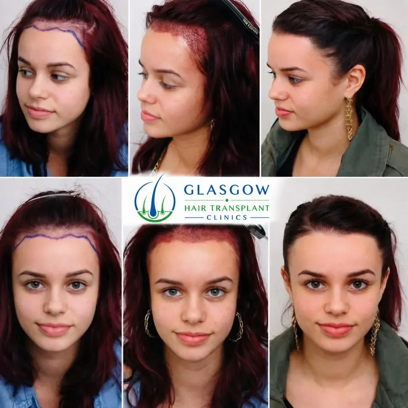 Hair restoration patient result