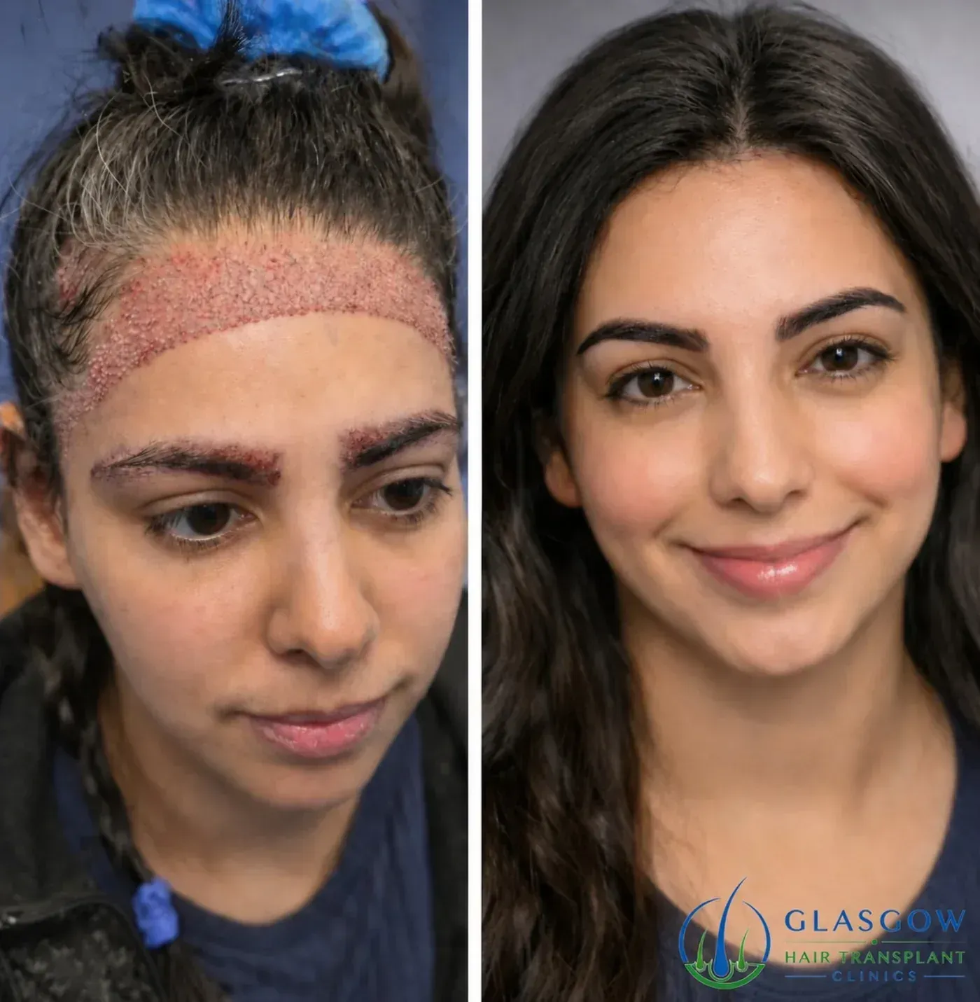 Fatima's hairline and eyebrow transplant result