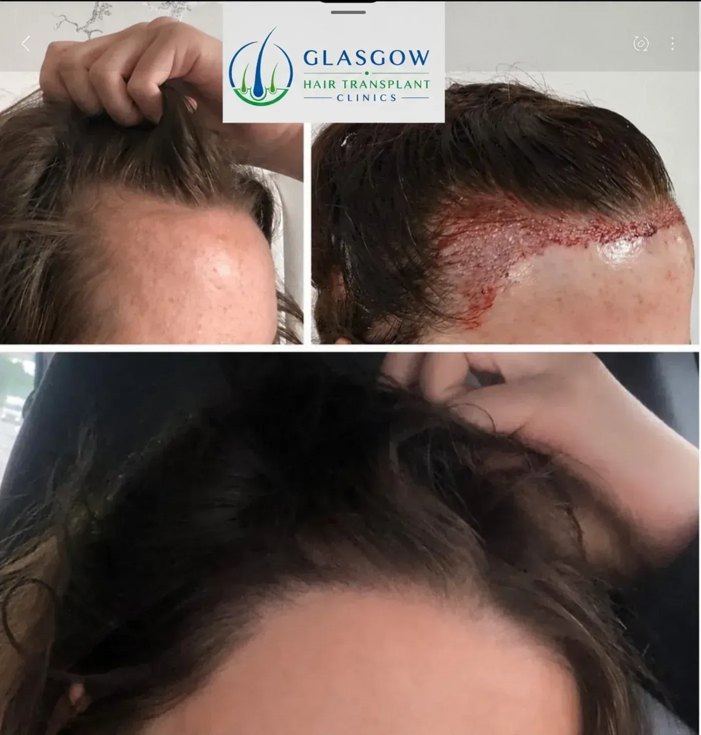 Temple and hairline transplant before and after 1,950 grafts