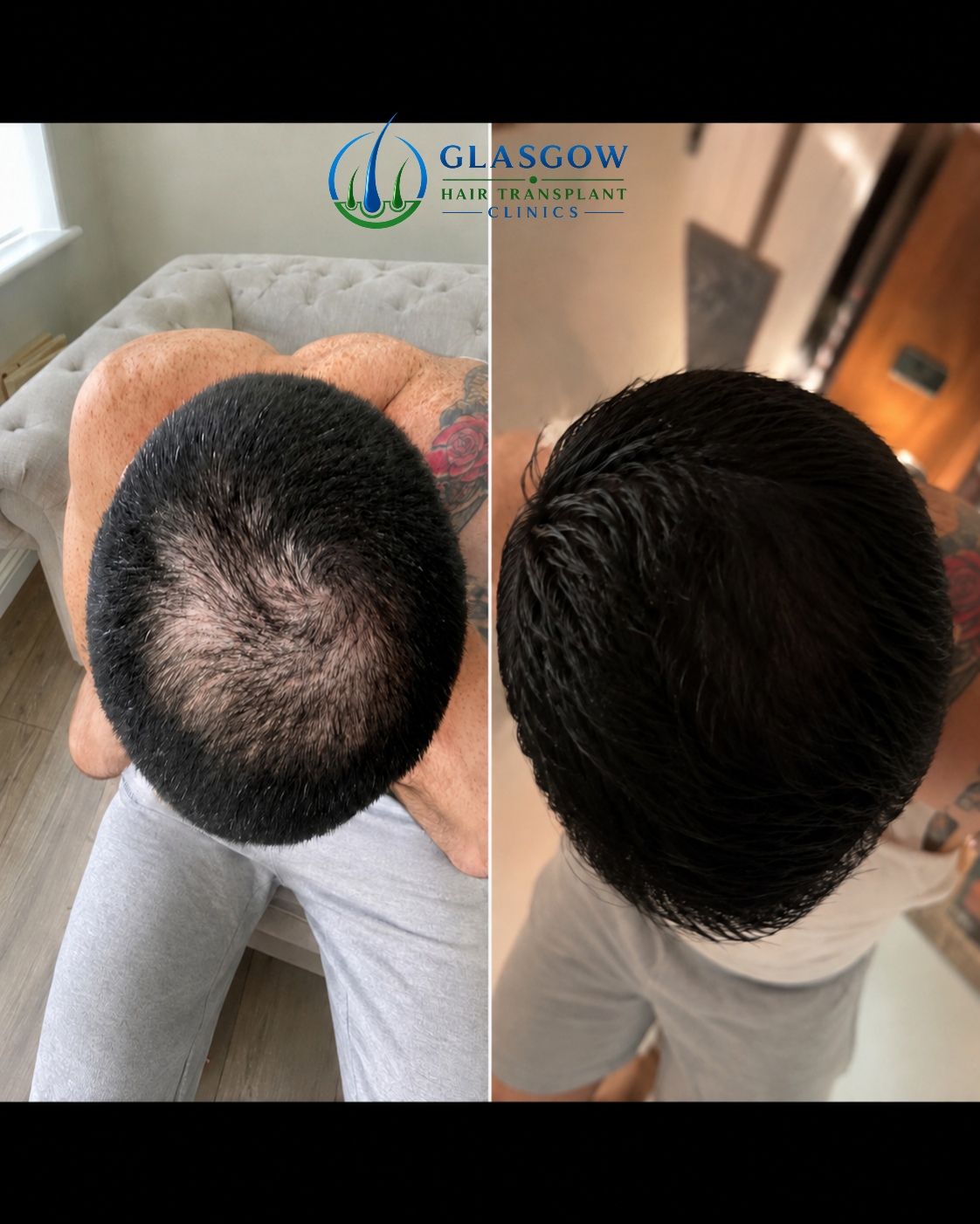 Crown hair transplant before and after Glasgow