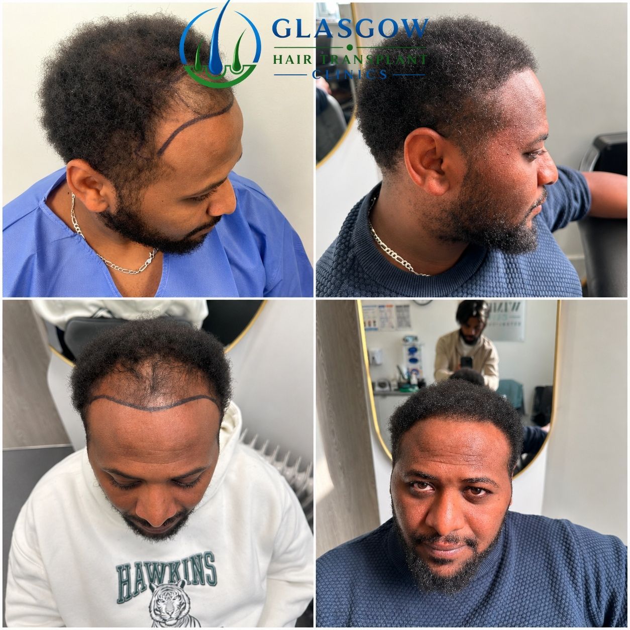 Hair transplant before and after result Glasgow