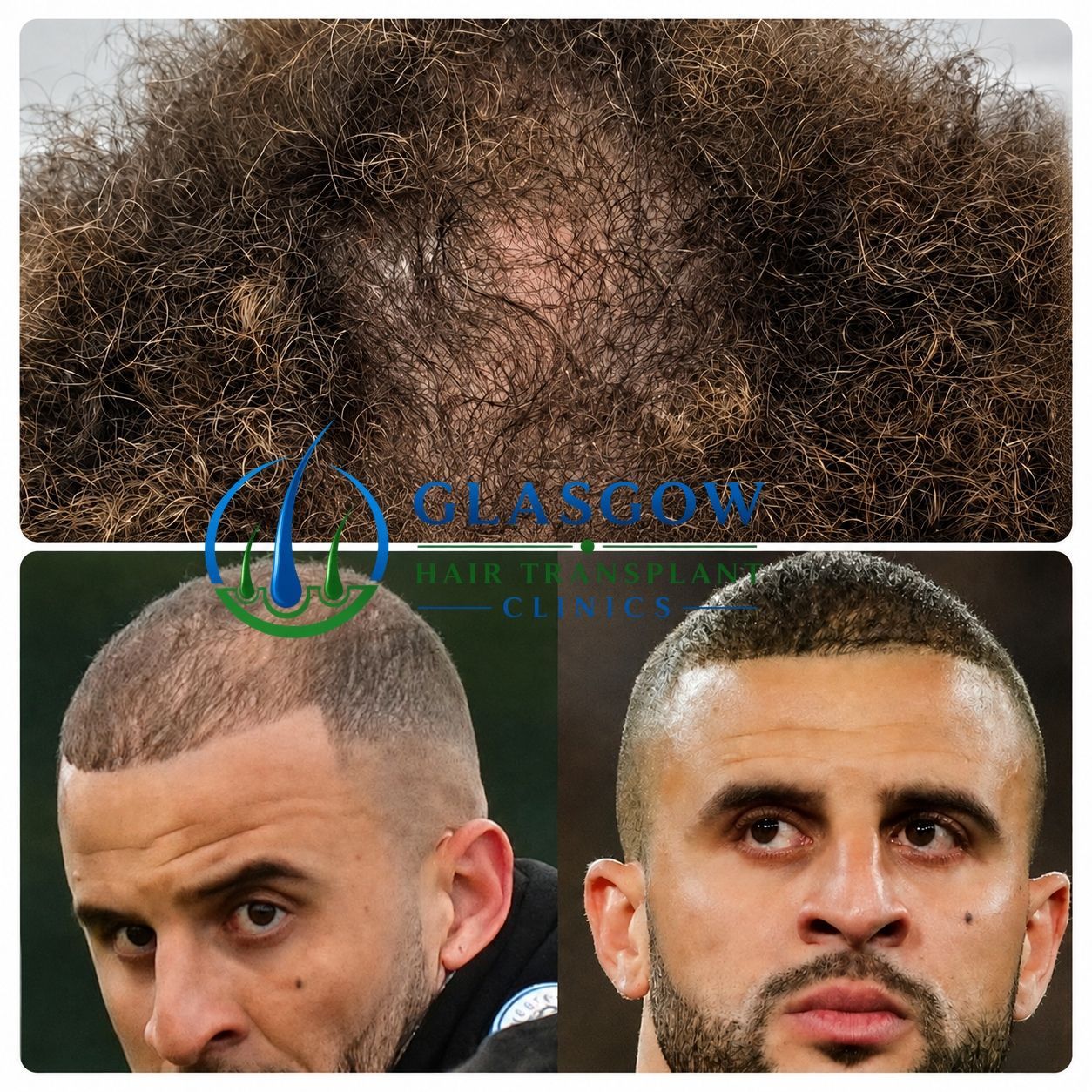 Hair transplant patient result Glasgow