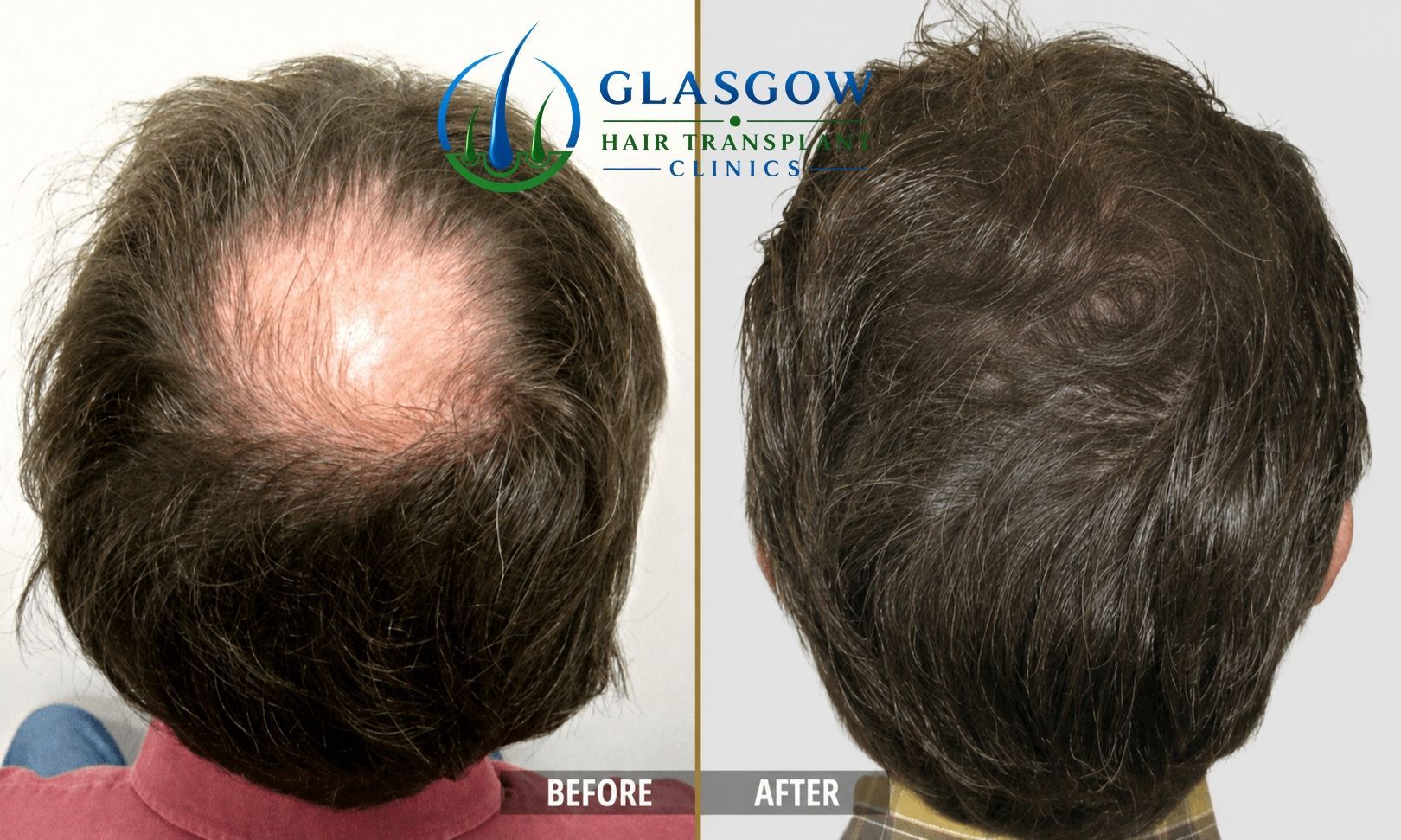 Crown hair restoration before and after result
