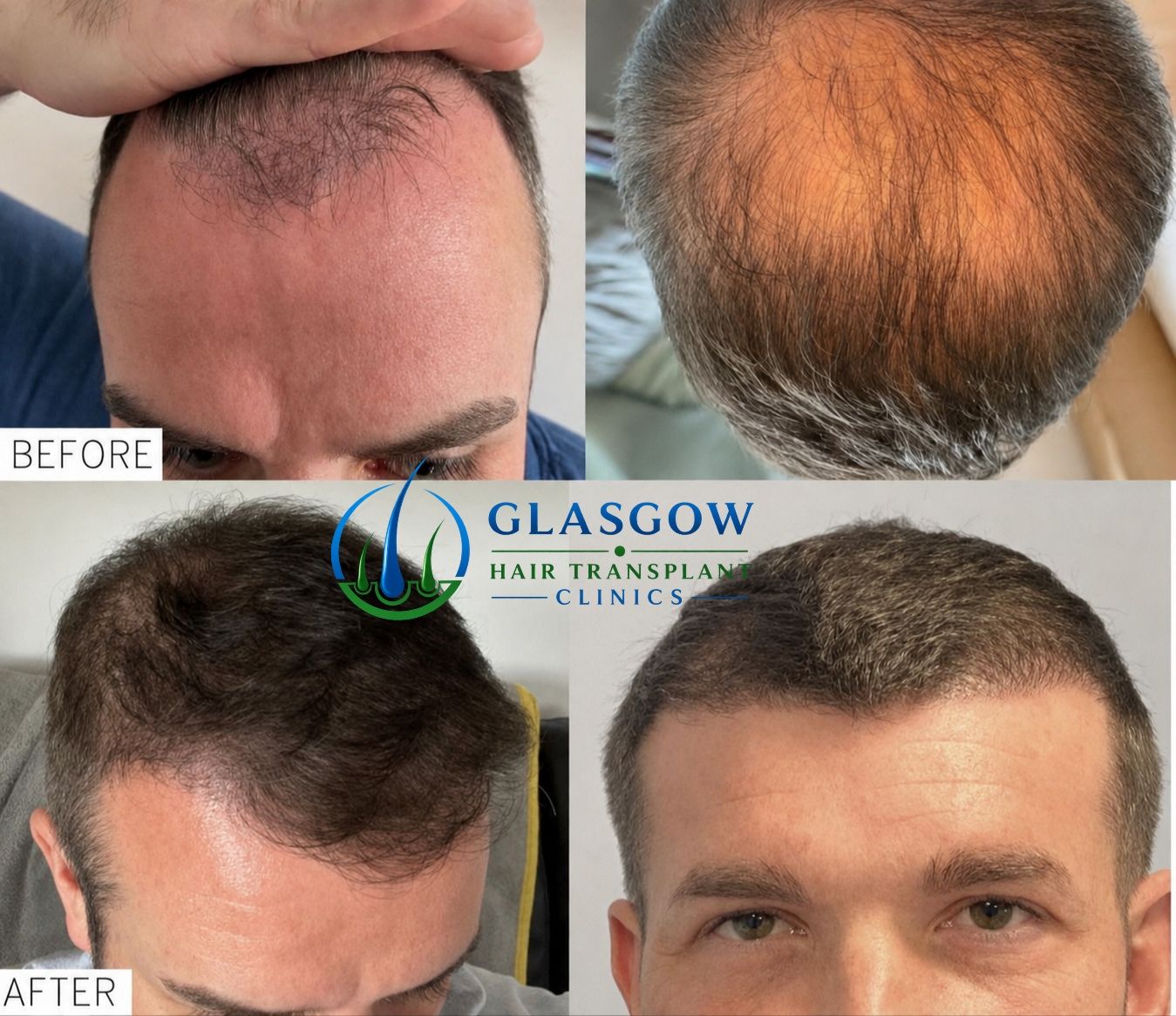 Hair transplant before and after result